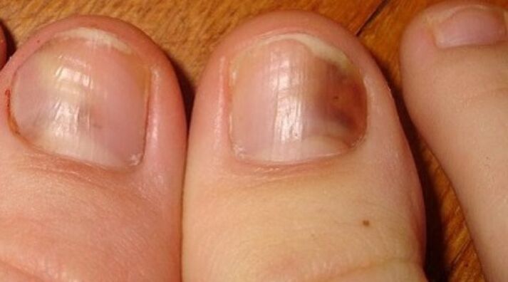 гъбична инфекция на ноктите