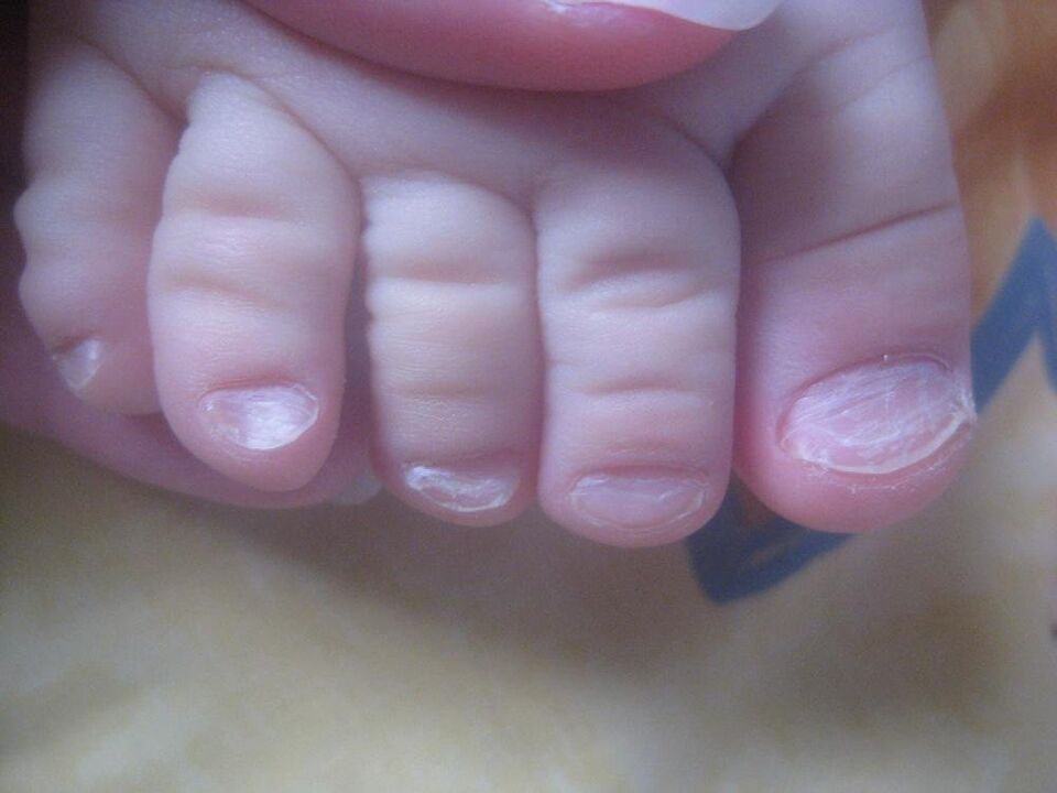 гъбички по ноктите на краката при деца