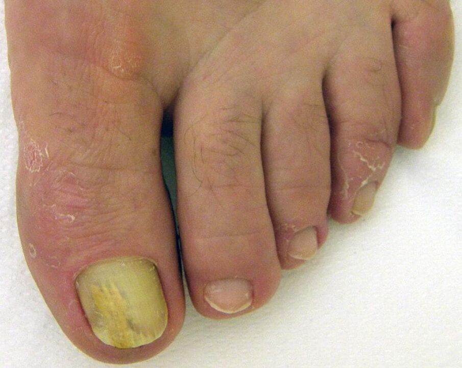 жълт нокът с гъбички как да се лекува с капки