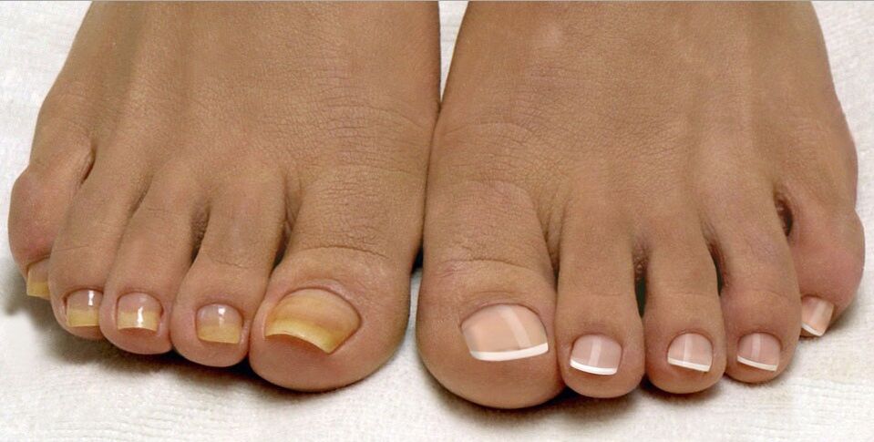 здрави нокти и гъбички по ноктите на краката