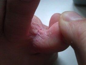 кожни лезии между пръстите на краката с гъбички