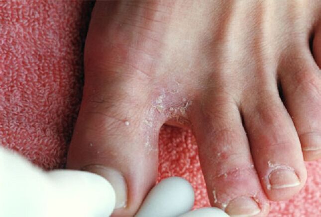 Прояви на интертригинозни гъбички между пръстите на краката