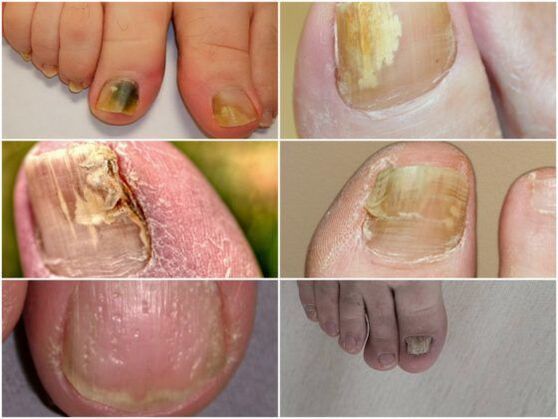 симптоми на гъбична инфекция на ноктите