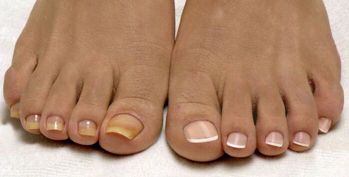 здрави нокти на краката и ноктите, засегнати от гъбички
