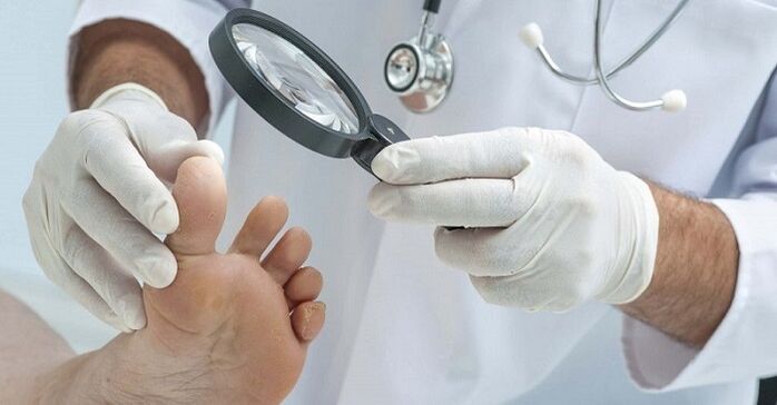 лекарят изследва краката за гъбички по ноктите