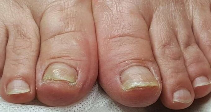 увреждане на ноктите с гъбички по краката