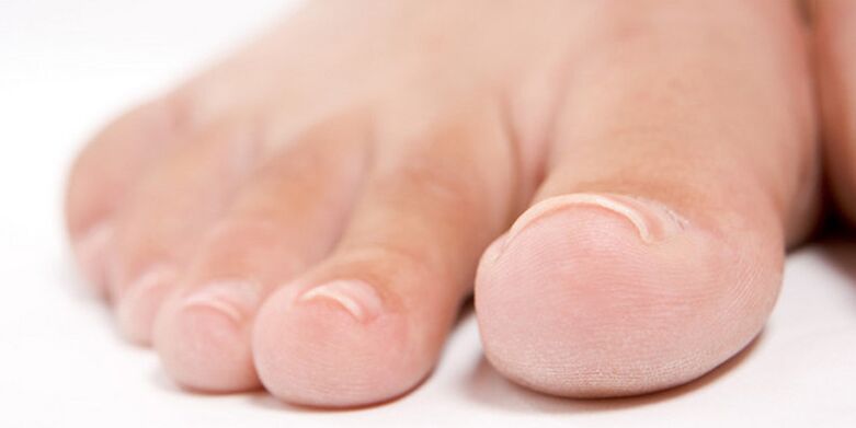 началният стадий на гъбички на ноктите на краката