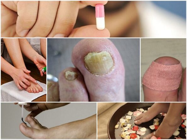 видове лекарства за гъбички по ноктите на краката