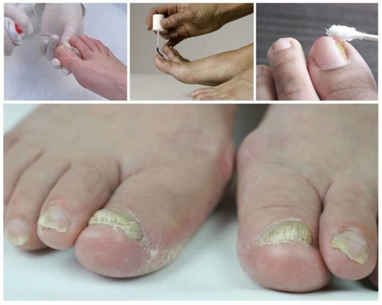 лекарства за гъбички по ноктите на краката