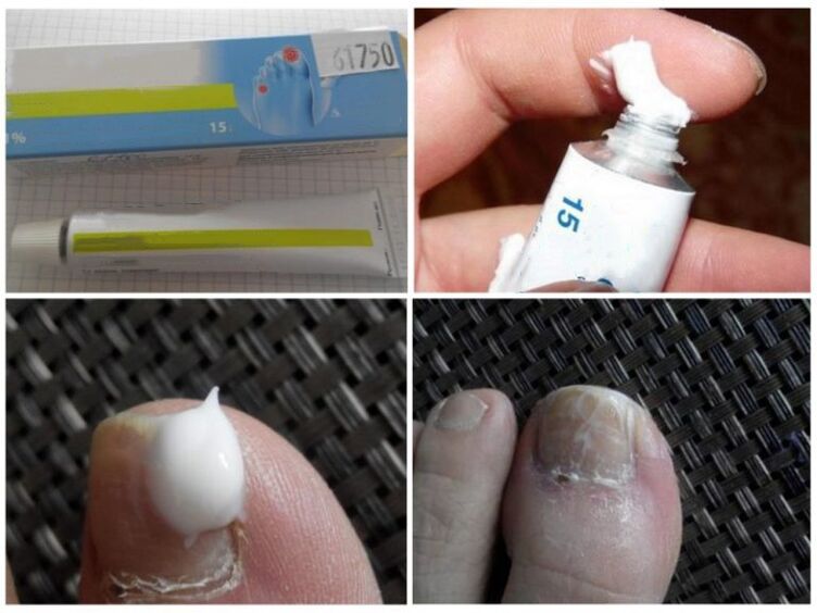 мехлеми срещу гъбички по ноктите на краката