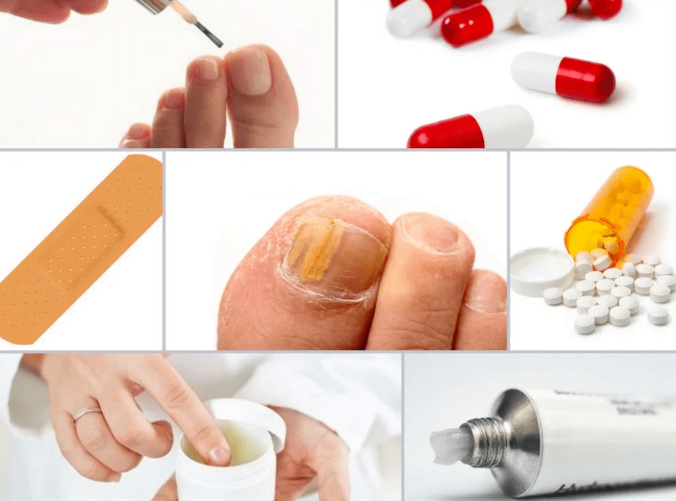 системни лекарства за гъбички по ноктите на краката