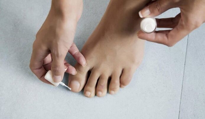 лечение на гъбички на палеца на крака с лак