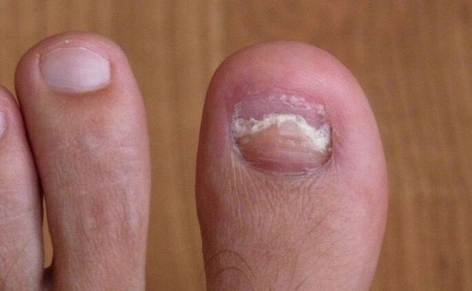 увреждане на нокътя на палеца на крака с гъбички