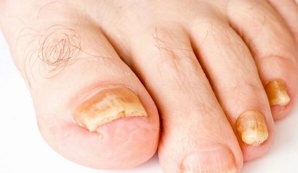 жълти нокти на краката при гъбични инфекции