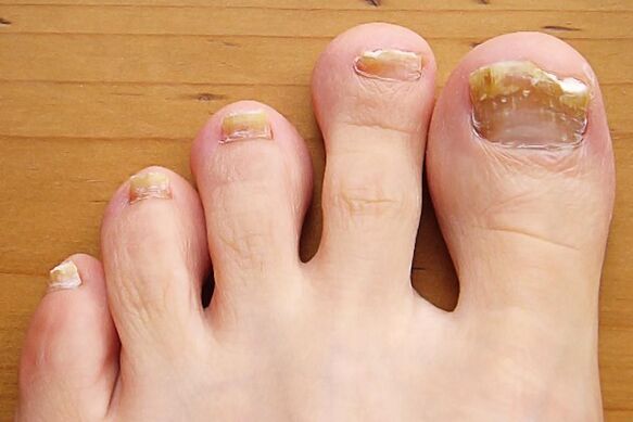 гъбички на ноктите на краката